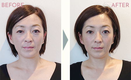 クラニアル整顔セラピービフォーアフター画像